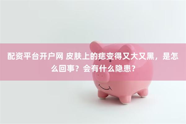 配资平台开户网 皮肤上的痣变得又大又黑，是怎么回事？会有什么隐患？